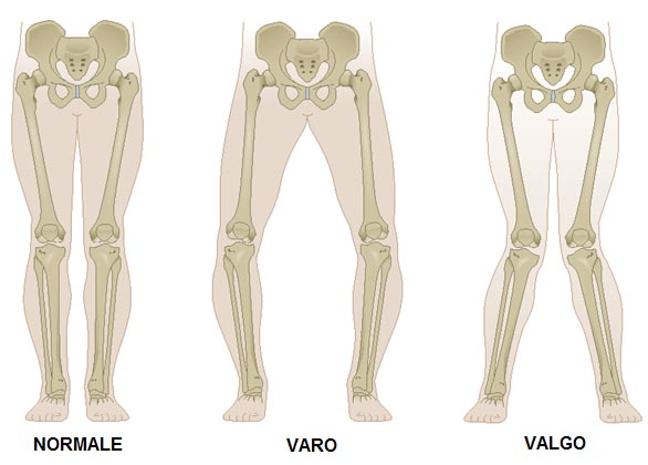 Ginocchio valgo esercizi e riabilitazione per correggerlo