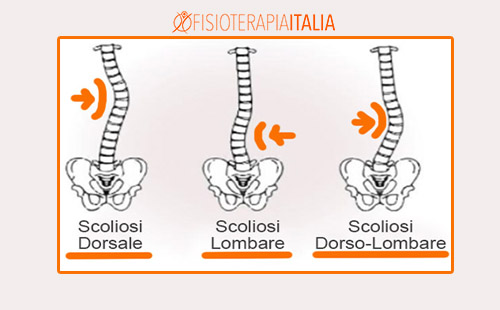 La scoliosi